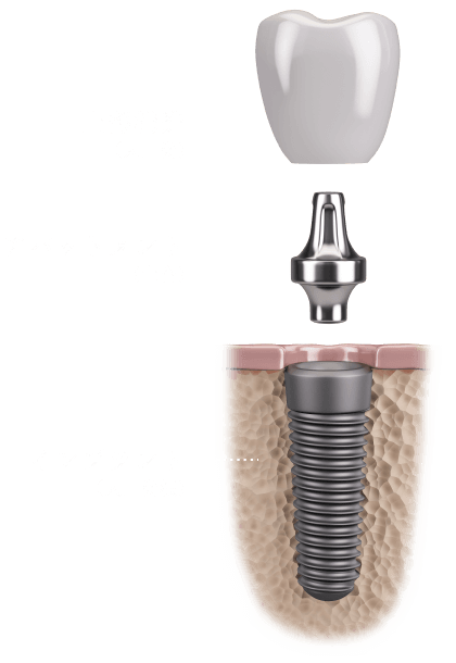 上部構造(人工歯)/アバットメント(土台)/インプラント(人工歯根)