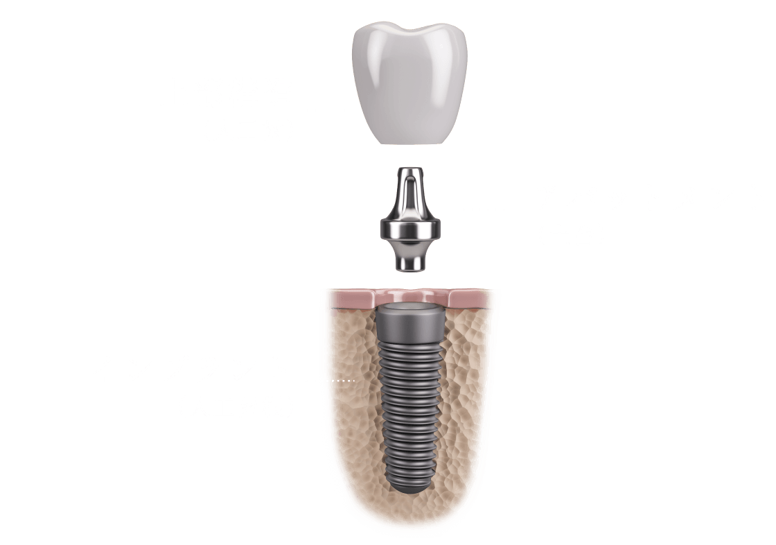 上部構造(人工歯)/アバットメント(土台)/インプラント(人工歯根)